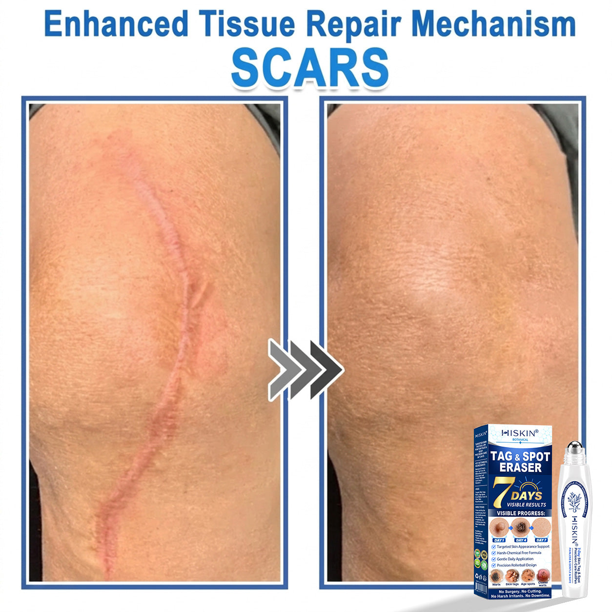𝐇𝐈𝐒𝐊𝐈𝐍®👩‍⚕️ 𝟕-𝐃𝒂𝘆 𝐒𝗸𝐢𝐧 𝐓𝒂𝗴 & 𝐒𝐩𝙤𝐭 𝐄𝐫𝒂𝐬𝙚𝐫 Painless & Scar-Free Advanced Imperfection Removal Rollerball Pen
