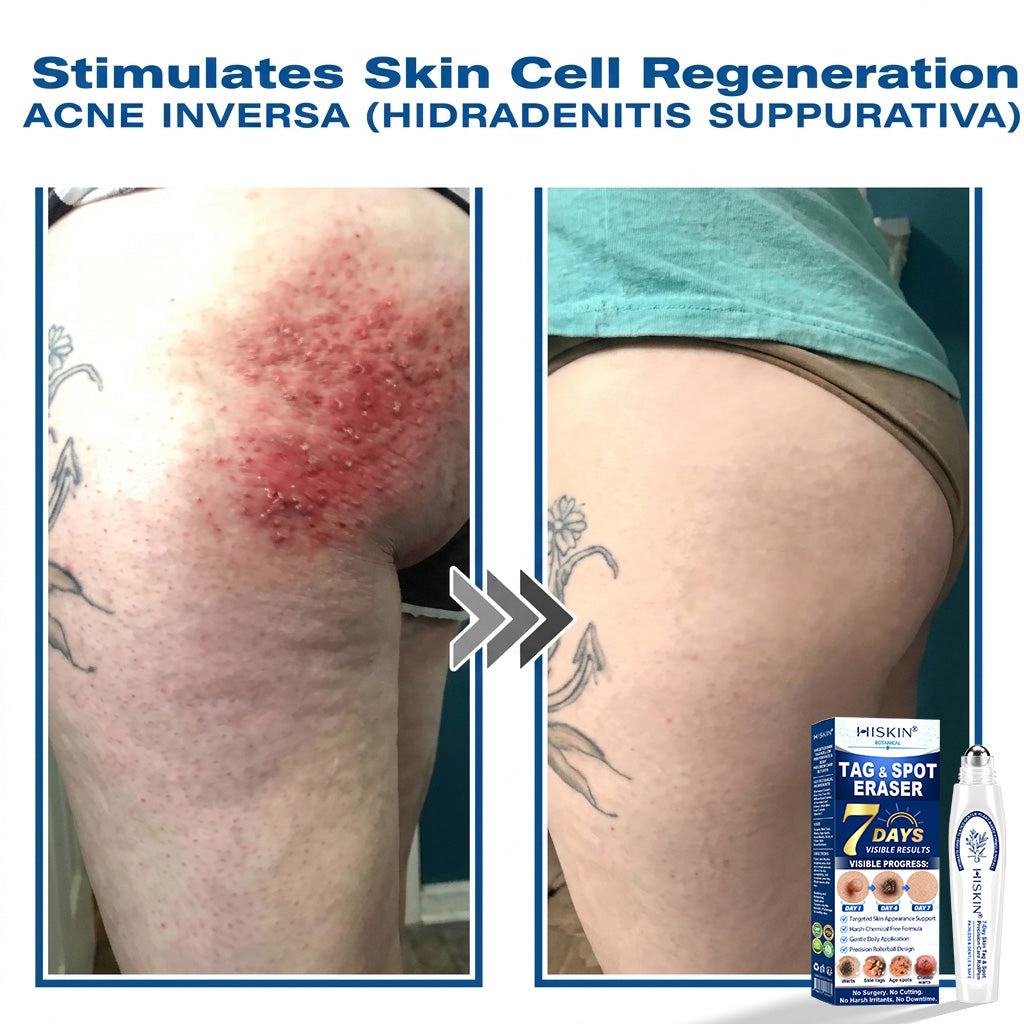 𝐇𝐈𝐒𝐊𝐈𝐍®👩‍⚕️ 𝟕-𝐃𝒂𝘆 𝐒𝗸𝐢𝐧 𝐓𝒂𝗴 & 𝐒𝐩𝙤𝐭 𝐄𝐫𝒂𝐬𝙚𝐫 Painless & Scar-Free Advanced Imperfection Removal Rollerball Pen