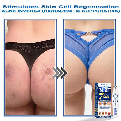 𝐇𝐈𝐒𝐊𝐈𝐍®👩‍⚕️ 𝟕-𝐃𝒂𝘆 𝐒𝗸𝐢𝐧 𝐓𝒂𝗴 & 𝐒𝐩𝙤𝐭 𝐄𝐫𝒂𝐬𝙚𝐫 Painless & Scar-Free Advanced Imperfection Removal Rollerball Pen