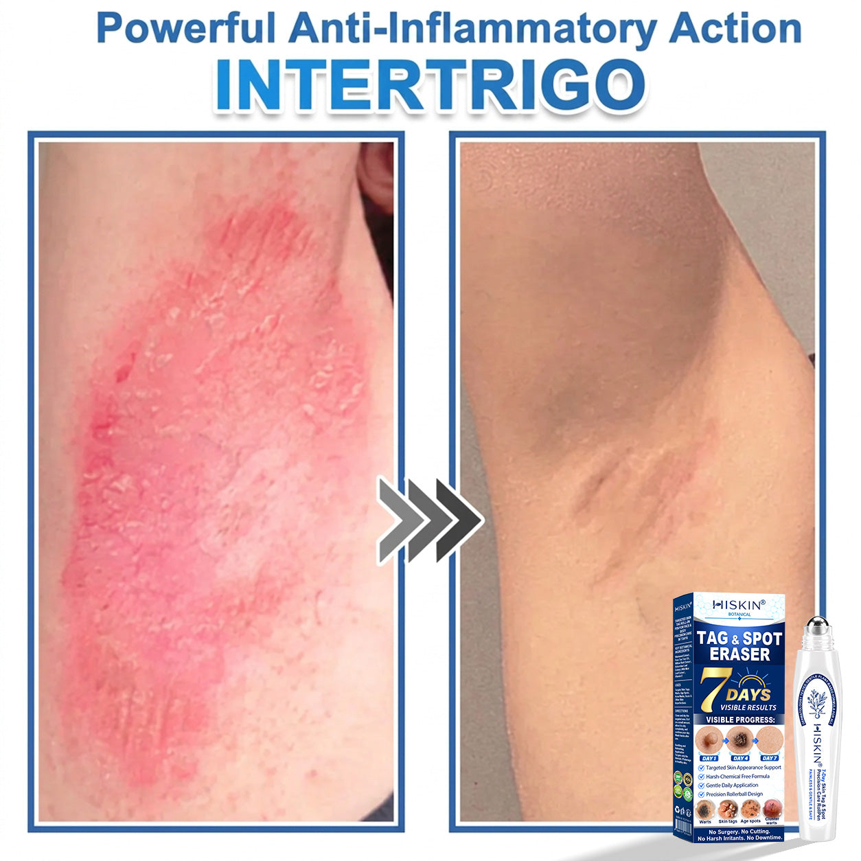 𝐇𝐈𝐒𝐊𝐈𝐍®👩‍⚕️ 𝟕-𝐃𝒂𝘆 𝐒𝗸𝐢𝐧 𝐓𝒂𝗴 & 𝐒𝐩𝙤𝐭 𝐄𝐫𝒂𝐬𝙚𝐫 Painless & Scar-Free Advanced Imperfection Removal Rollerball Pen