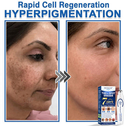 𝐇𝐈𝐒𝐊𝐈𝐍®👩‍⚕️ 𝟕-𝐃𝒂𝘆 𝐒𝗸𝐢𝐧 𝐓𝒂𝗴 & 𝐒𝐩𝙤𝐭 𝐄𝐫𝒂𝐬𝙚𝐫 Painless & Scar-Free Advanced Imperfection Removal Rollerball Pen