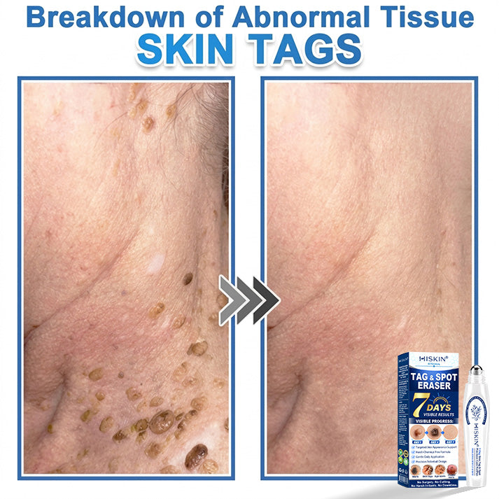 𝐇𝐈𝐒𝐊𝐈𝐍®👩‍⚕️ 𝟕-𝐃𝒂𝘆 𝐒𝗸𝐢𝐧 𝐓𝒂𝗴 & 𝐒𝐩𝙤𝐭 𝐄𝐫𝒂𝐬𝙚𝐫 Painless & Scar-Free Advanced Imperfection Removal Rollerball Pen