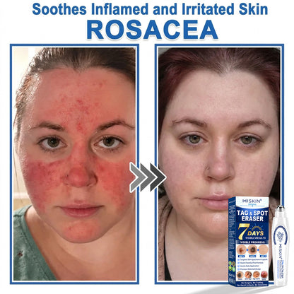 𝐇𝐈𝐒𝐊𝐈𝐍®👩‍⚕️ 𝟕-𝐃𝒂𝘆 𝐒𝗸𝐢𝐧 𝐓𝒂𝗴 & 𝐒𝐩𝙤𝐭 𝐄𝐫𝒂𝐬𝙚𝐫 Painless & Scar-Free Advanced Imperfection Removal Rollerball Pen