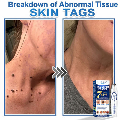 𝐇𝐈𝐒𝐊𝐈𝐍®👩‍⚕️ 𝟕-𝐃𝒂𝘆 𝐒𝗸𝐢𝐧 𝐓𝒂𝗴 & 𝐒𝐩𝙤𝐭 𝐄𝐫𝒂𝐬𝙚𝐫 Painless & Scar-Free Advanced Imperfection Removal Rollerball Pen