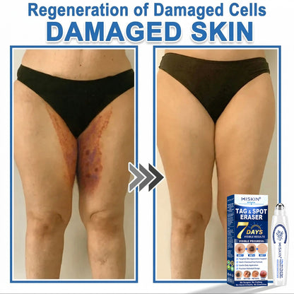 𝐇𝐈𝐒𝐊𝐈𝐍®👩‍⚕️ 𝟕-𝐃𝒂𝘆 𝐒𝗸𝐢𝐧 𝐓𝒂𝗴 & 𝐒𝐩𝙤𝐭 𝐄𝐫𝒂𝐬𝙚𝐫 Painless & Scar-Free Advanced Imperfection Removal Rollerball Pen